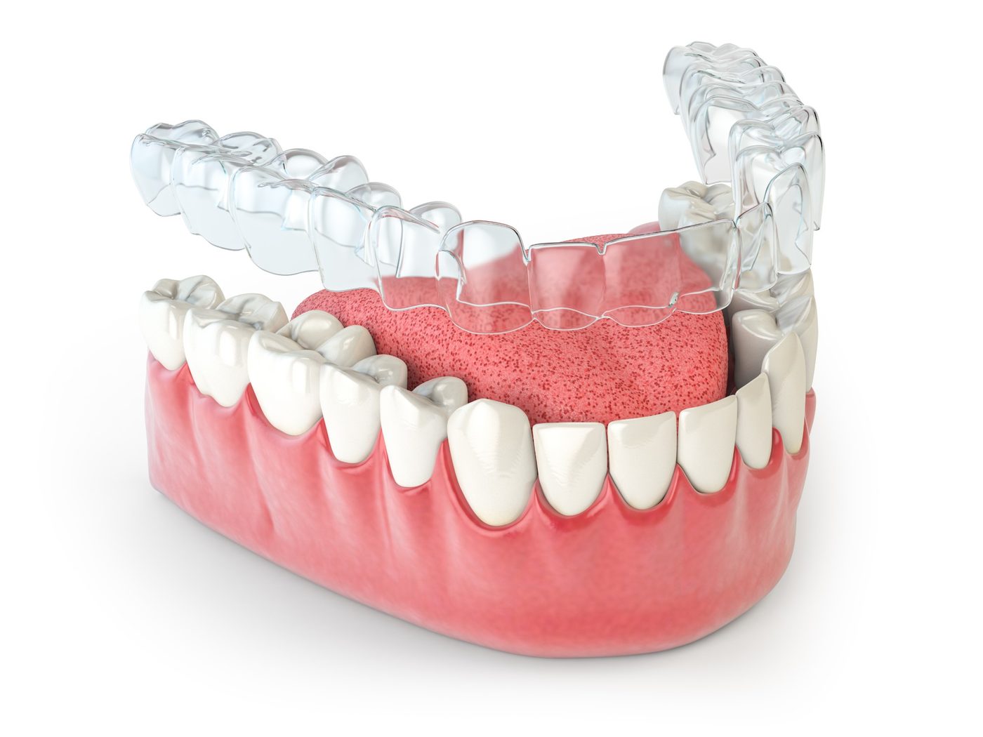 A 3D digital model of a patient's teeth on screen, showing the planned aligner result