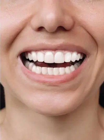 The same smile with even, aligned front teeth after aligner treatment