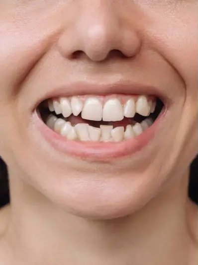 A smile with crowded, uneven front teeth before aligner treatment