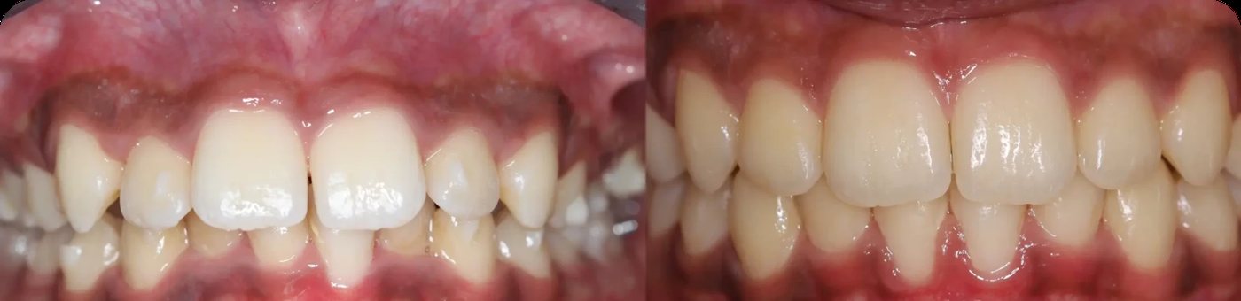 Close-up clinical view: crowded teeth before, aligned teeth after