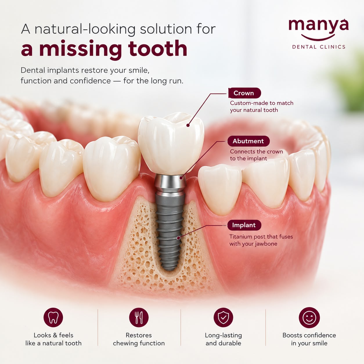 Dental implant diagram: a custom-made crown that matches your natural tooth, an abutment that connects the crown to the implant, and a titanium implant post that fuses with your jawbone